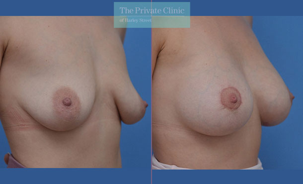 breast uplift with enlargement breast implants and mastopexy results