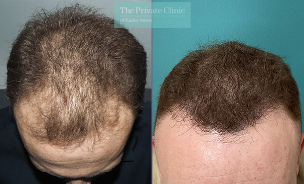 FUE Hair Transplant - 051MM