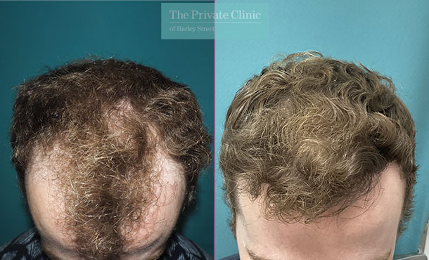 Hair Transplant - 054MM - Front