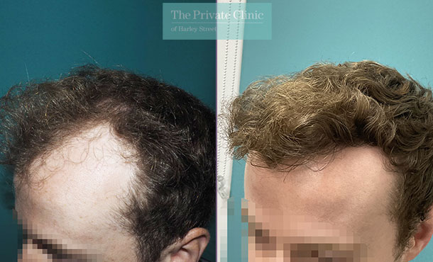 Hair Transplant - 054MM - Side