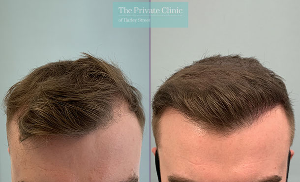 Hair Transplant - 026FR