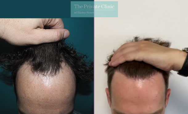 Hair Transplant - 055MM