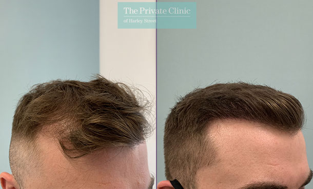 Hair Transplant - 026FR - Side