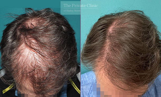 Hair Transplant - 053MM - Front