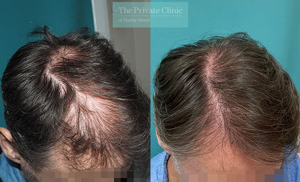 fue hair transplants results for hairloss midscalp