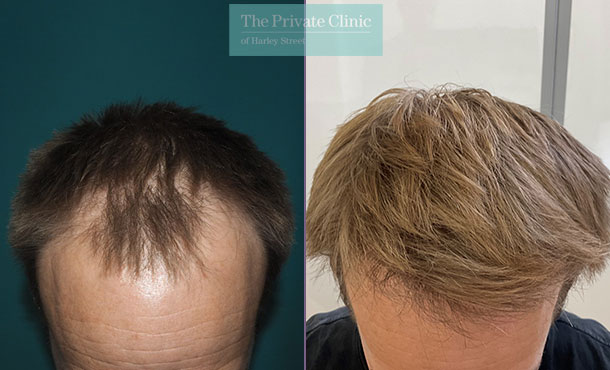 hair transplant hairline restoration temples before after results