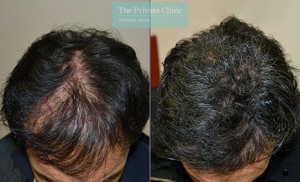 fue hair transplant hair loss restoration results midscalp crown