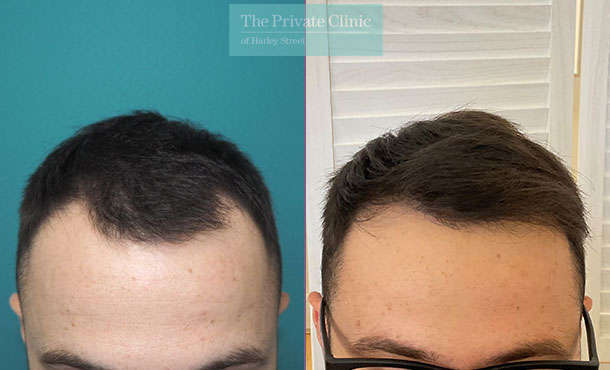 FUE Hair Transplant - 056MM - Front