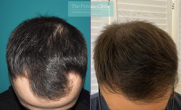 FUE Hair Transplant - 056MM - Top