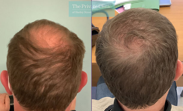 FUE Hair Transplant - 027FR