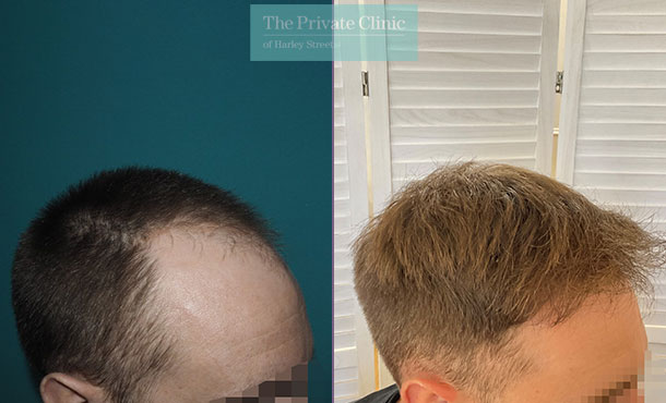 FUE Hair Transplant - 057MM - Side