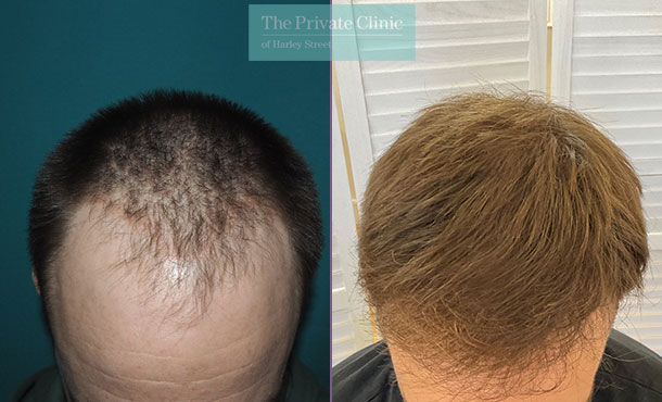 FUE Hair Transplant - 057MM - Top