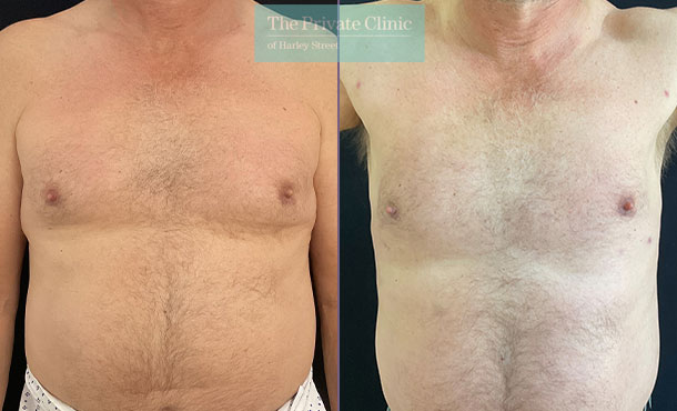 Vaser Lipo/Male Chest - 017L-MM