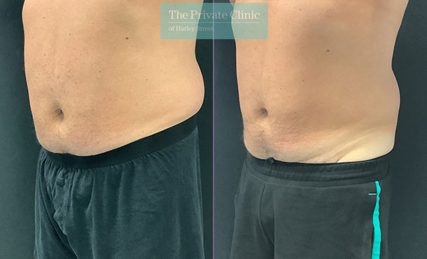 CoolSculpting Male Lower Abdomen Before After Pictures, Men Flanks Fat  removal