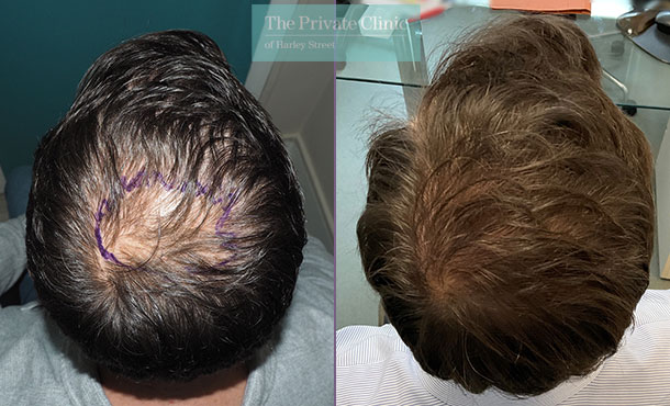 fue-hair-transplant-for-men-crown-18-months-after-2482-hairs-979-grafts