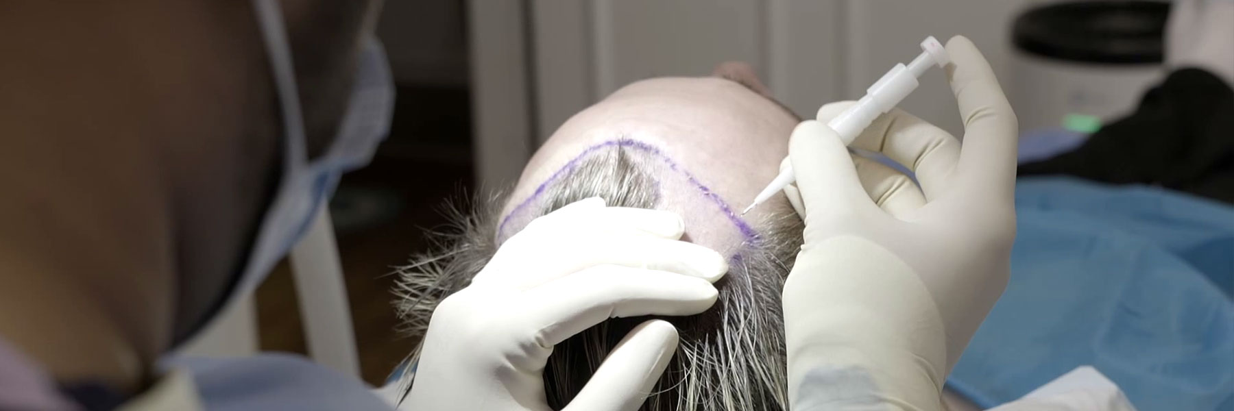 hair-transplant-fue-hair-restoration-surgery-london-UK-3