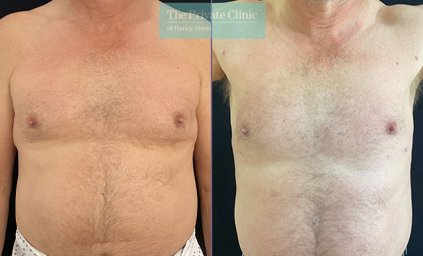 Vaser Liposuction Chest & Armpits/Axillary before and after photo