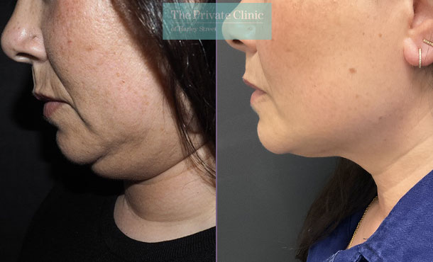 Chin Liposuction before and after photo