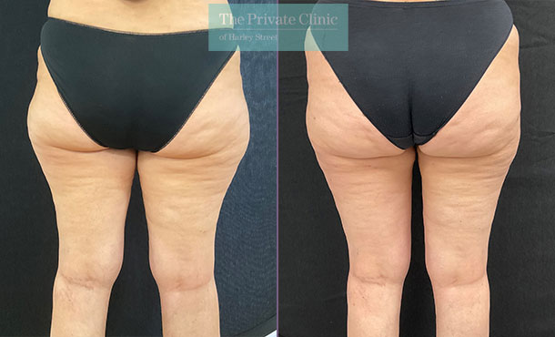 Inner & Outer Thighs before and after photo