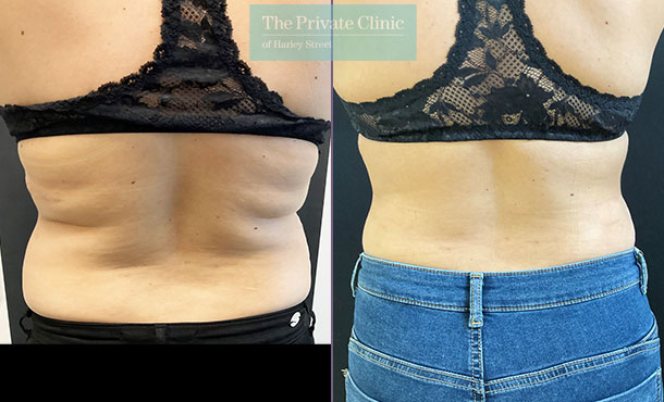 Microlipo Upper Abdomen & Mid Back backside before and after photo