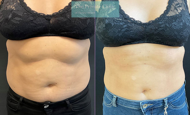 Microlipo Upper Abdomen & Mid Back  front before and after photo