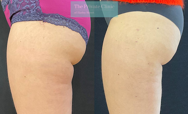 Lower Buttocks/Banana Fold/ Gluteal Fold Liposuction before and after photo
