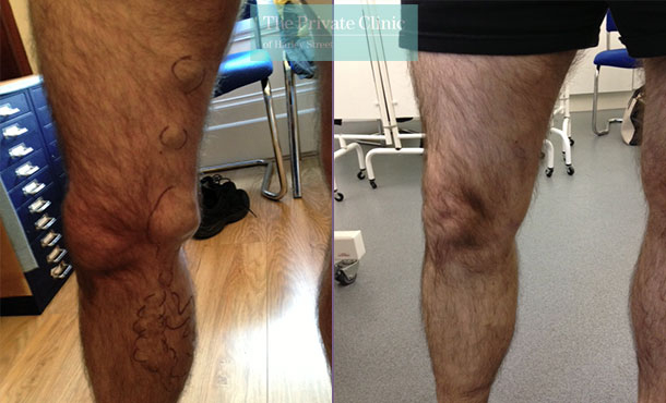 bulging leg veins before and after treatment results photos Bournemouth