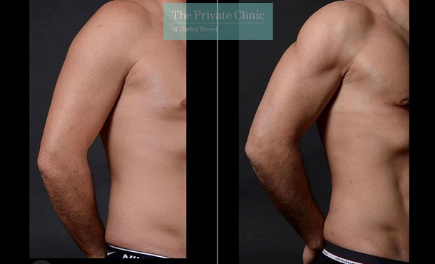 Vaser Hi-Def Liposuction Chest, Abdomen, Flanks, Upper Arms side before and after photo