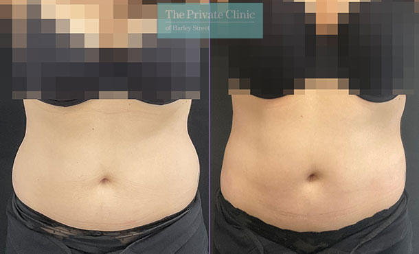 Liposuction Abdomen, Flanks & Mid Back before and after photo