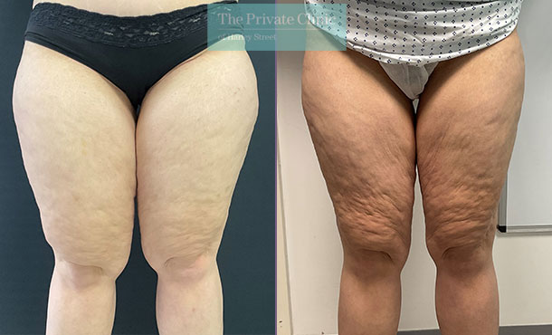 lipoedema legs liposuction before after photo