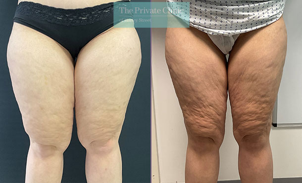 Vaser Liposuction Outer & Anterior Thighs before and after photo