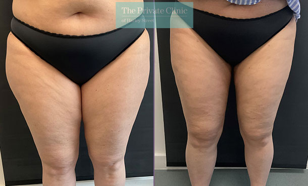 Liposuction Inner & Outer Thighs before and after photo