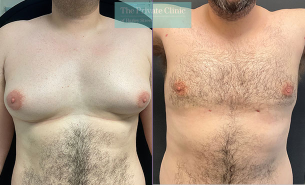 Liposuction male breast reduction before and after photo