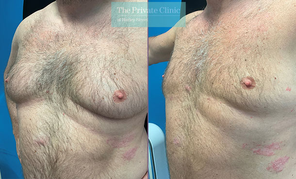 Liposuction male Chest reduction before and after photo
