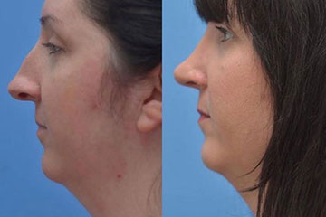 rhinoplasty nose job surgery patient story before after photos