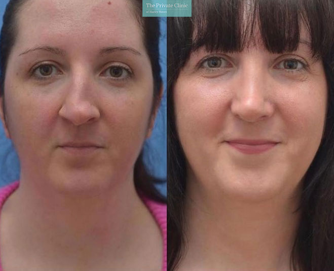 Rhinoplasty nose job nasal deviation before and after photos uk
