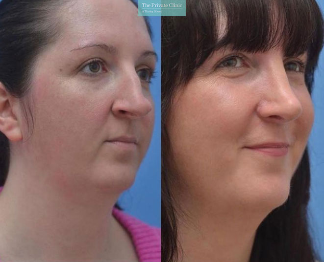 nasal deviation nose surgery female before and after photos