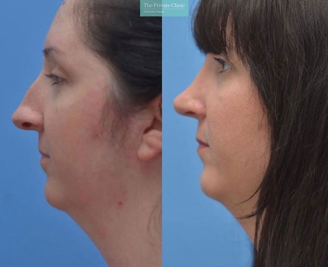 nasal deviation Rhinoplasty nose job before and after results female side