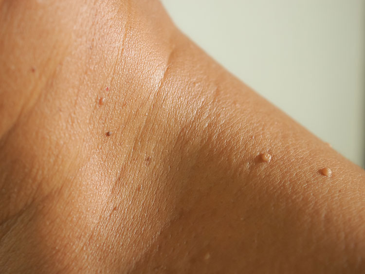 skin tag removal