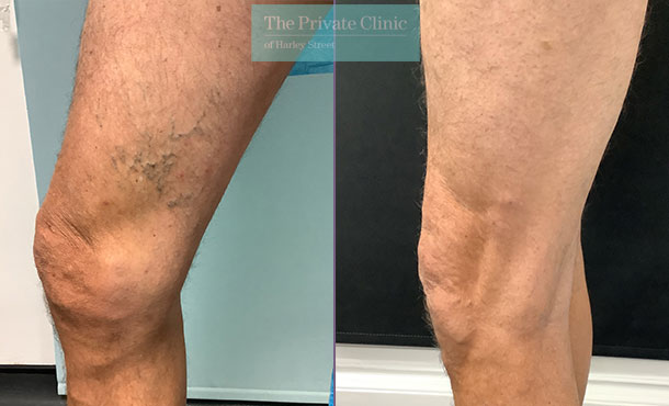 varicose-vein-removal-foam-sclerotherapy-phlebectomy-before-after-photos