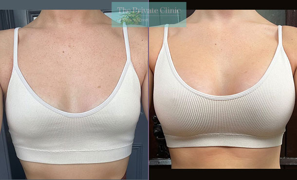 breast-augmentation-enlargement-implants-surgery-before-after-results