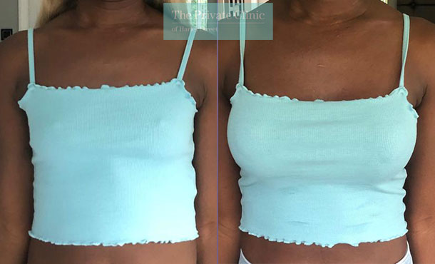 breast-augmentation-enlargement-surgery-uk-before-after-results