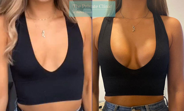 Breast Augmentation - 092AR-BA