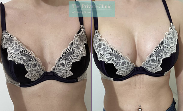 Breast Augmentation - 094AR-BA