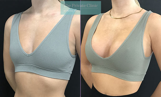 The “Drop and Fluff” Process After Breast Augmentation