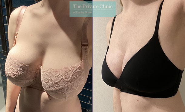 Breast Reduction - 085AR-R