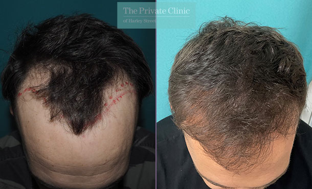 Hair Transplant - 060MM-front
