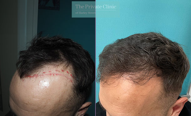 Hair Transplant - 060MM