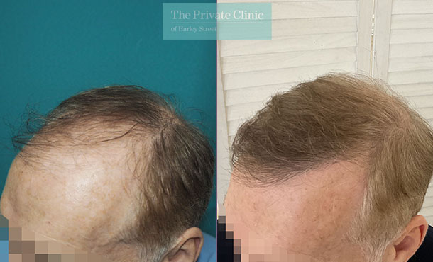 Hair Transplant - 059MM