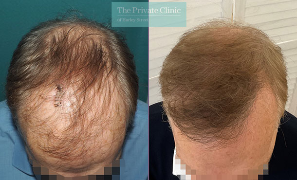 Hair Transplant - 059MM-Front
